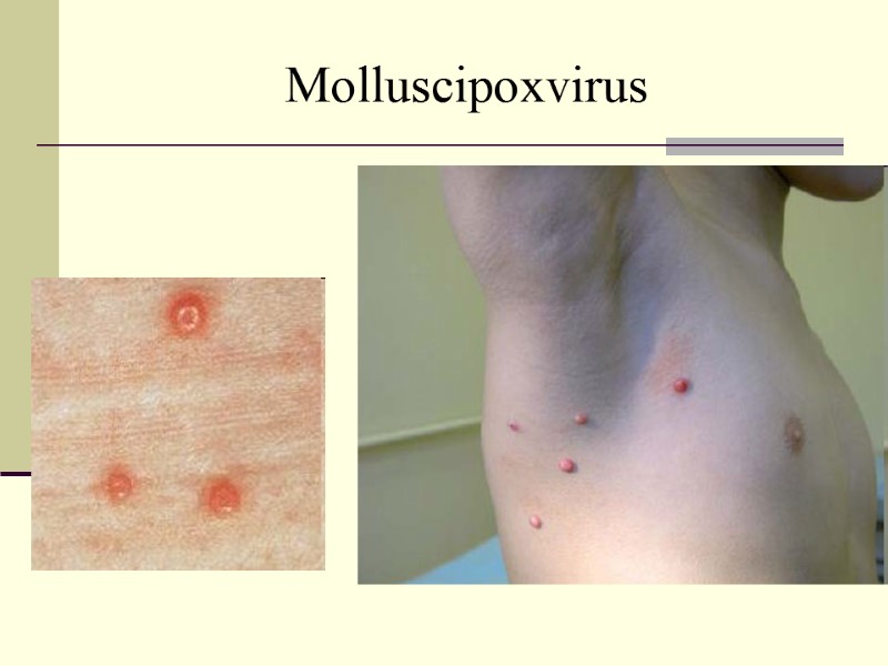 Molluscipoxvirus